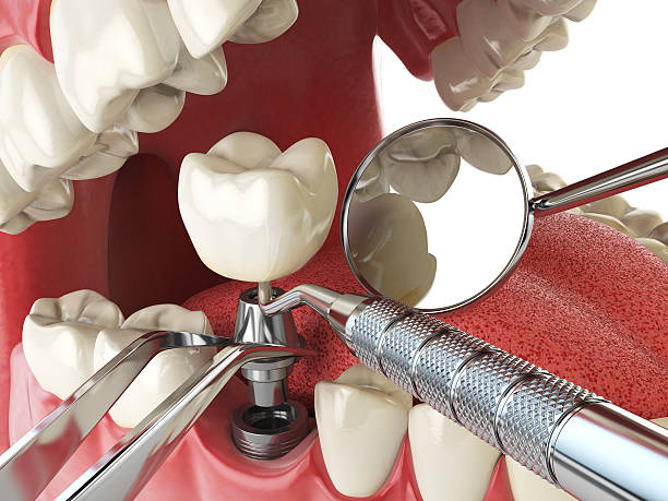 Best Emergency Treatment for Dental Infections or Abscesses in Wadley, GA